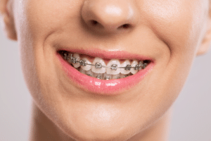 Close-up of a person smiling with metal braces on their upper and lower teeth.